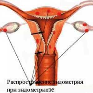Генитална ендометриоза