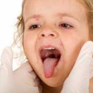 Херпанги при деца - Лечение