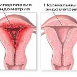 Хиперплазия на ендометриума и бременност