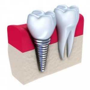 Зъбните импланти - противопоказания и възможни усложнения