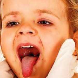 Как за лечение на херпес на устата в гърлото на детето?