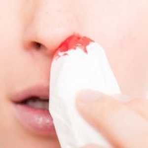 Как да спрем кръвотечение от носа?