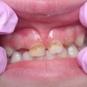 Кариес млечни зъби