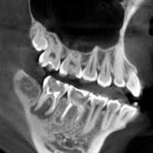 Компютърна томография зъби