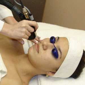 Лазерът е показал отлични резултати в подмладяване на кожата