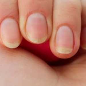 Чупливи нокти - причини