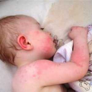 Мехлем от алергии за деца