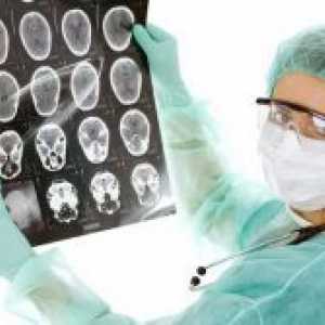 Мозъчен тумор - симптоми в ранните етапи