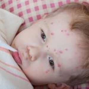 Усложнения от варицела при деца