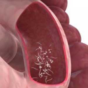 Pinworms при деца - симптоми