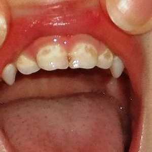 Петна по зъбите на детето
