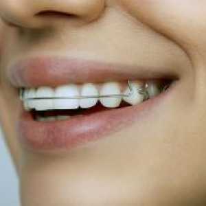 Плочки за подравняване зъби