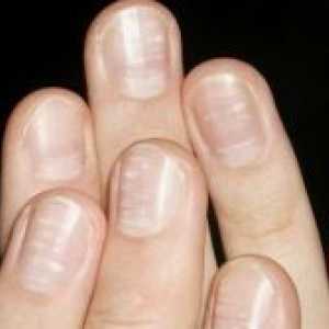 Защо ноктите стават вълнообразни?