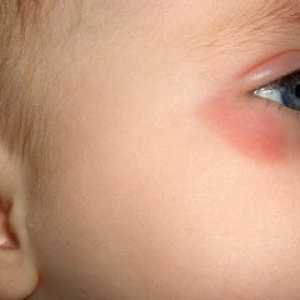 Защо едно дете може да бъде червено под очите