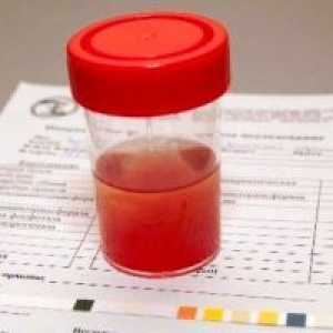 Увеличени червените кръвни клетки в урината