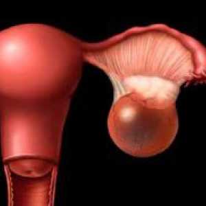 Симптомите на кисти на яйчниците при жените