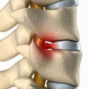 Рак на гръбначния стълб - Симптоми и признаци