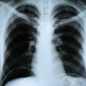 Рентгенография на гръдния кош