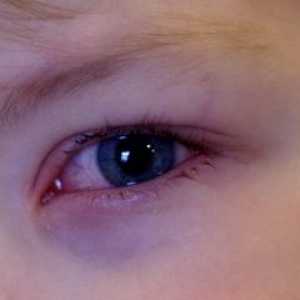 Детето има червени очи, защо и какво да правя?