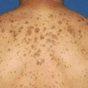 Видове пигментни петна по кожата и тяхното лечение