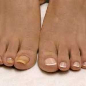 Жълтите нокти на краката
