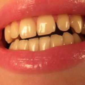 Жълти зъби
