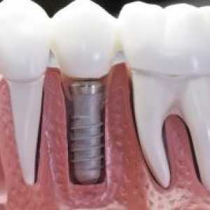 Зъбните импланти - "за" и "против"